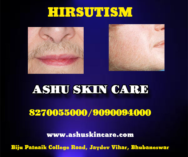 best hirsutism treatment clinic in bhubaneswar close to sum hospital